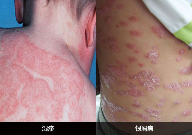 湿疹和银屑病区别对比图片