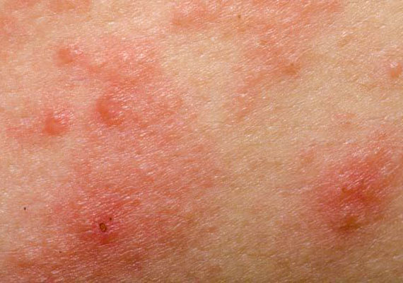 湿疹引起的发痒的皮肤红疹图片