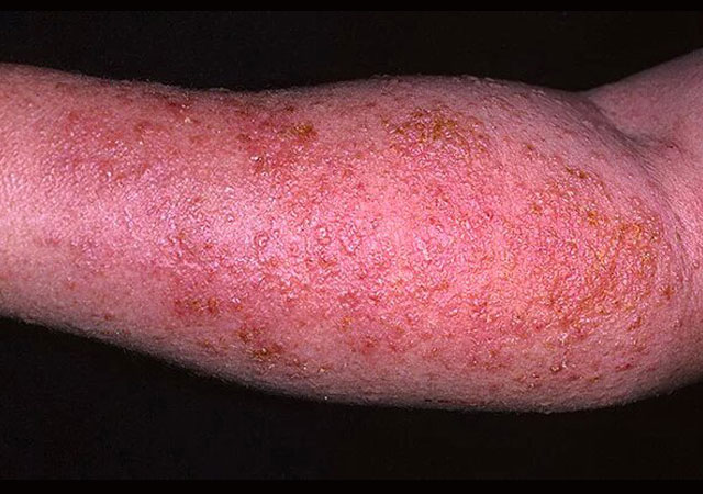 湿疹的外观症状表现图片
