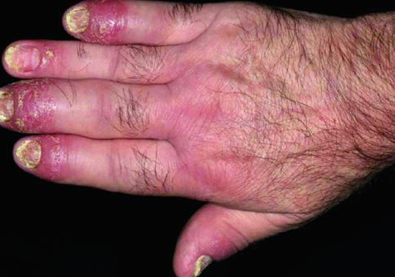 手部关节型牛皮癣症状图片