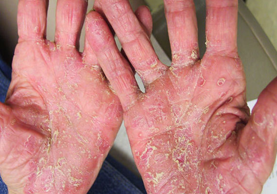 手部红皮型银屑病症状图片