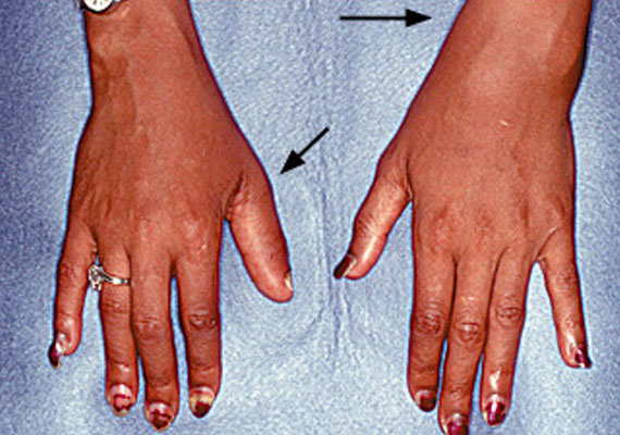 手和手腕银屑病关节炎的症状图片