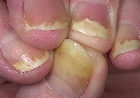 手指甲银屑病图片1