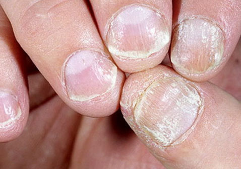 手指甲银屑病图片2