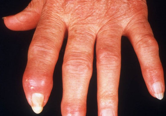 手指银屑病关节炎的症状图片