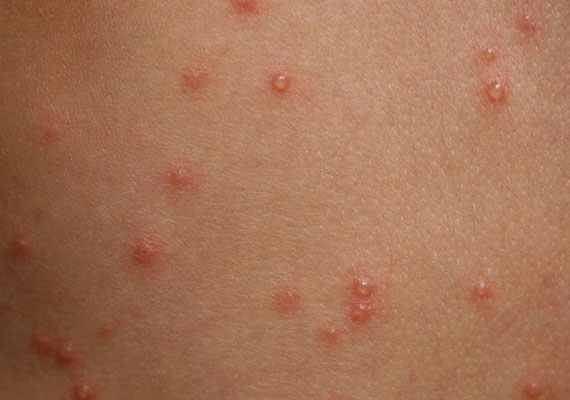 水痘引起的发痒的皮肤红疹图片