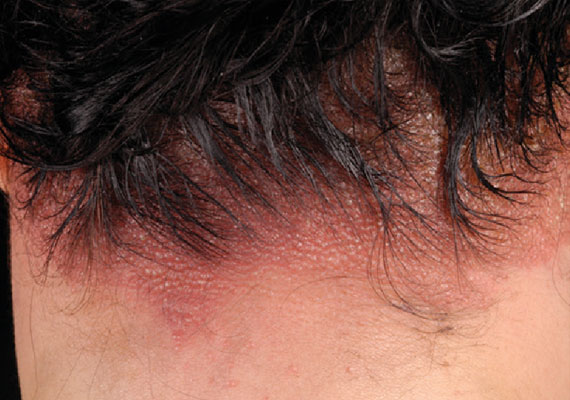 头皮皮肤病过敏性接触性皮炎图片