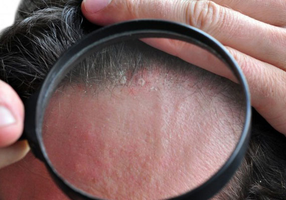 头上有牛皮癣图片早期症状为丘疹并覆盖干燥皮肤