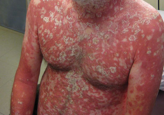 胸部红皮型银屑病症状图片