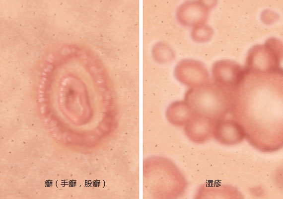 癣和湿疹的区别对比图片