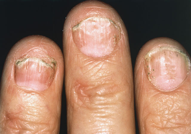 寻常型银屑病症状指甲样子图片