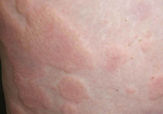 荨麻疹引起的发痒的皮肤红疹图片