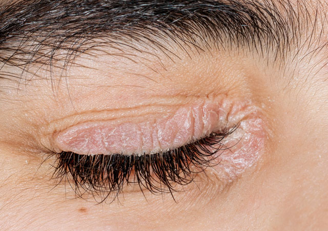 眼睛周围的银屑病对眼睛的危害非常严重