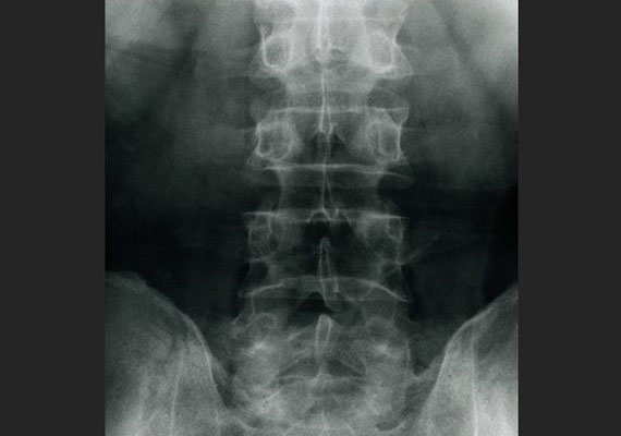 银屑病性脊柱炎和强制性脊柱炎的区别
