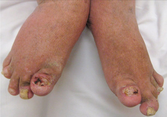 银屑病关节炎脚趾甲与脚背的指甲牛皮癣图片
