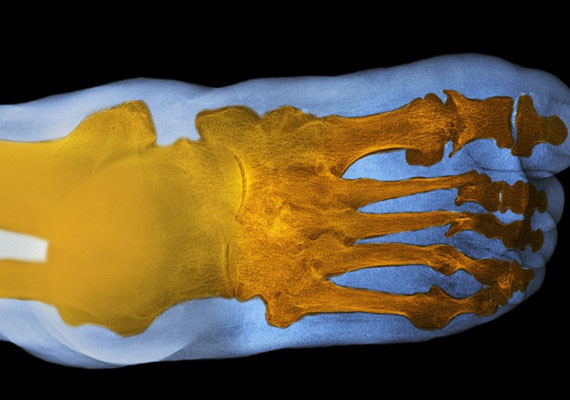 银屑病关节炎脚和跖骨，趾骨，脚趾的X射线图片