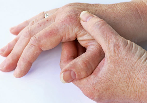 手部银屑病关节炎临床表现