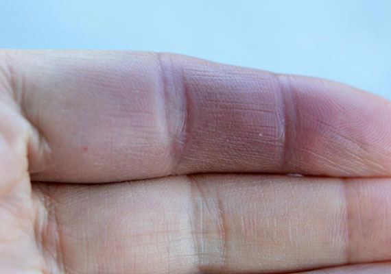 银屑病关节炎手指红肿症状图片