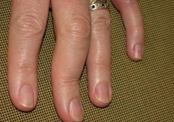 银屑病关节炎手指图片