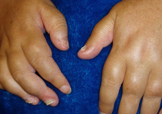 银屑病关节炎手肿并出现指甲变化
