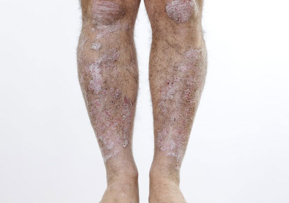银屑病关节炎早期腿部斑块状牛皮癣图片