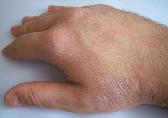 银屑病关节炎手指肿胀怎么消肿