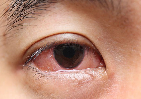 银屑病关节炎眼睛症状图片