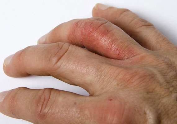 手指银屑病关节炎早期症状肿胀和疼痛