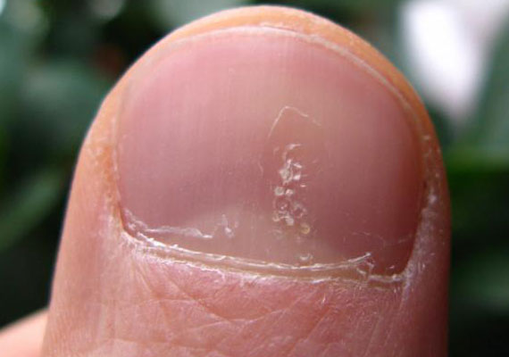 银屑病关节炎手指甲麻点图片