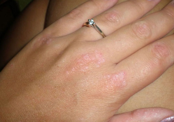 手部女性银屑病早期症状表现