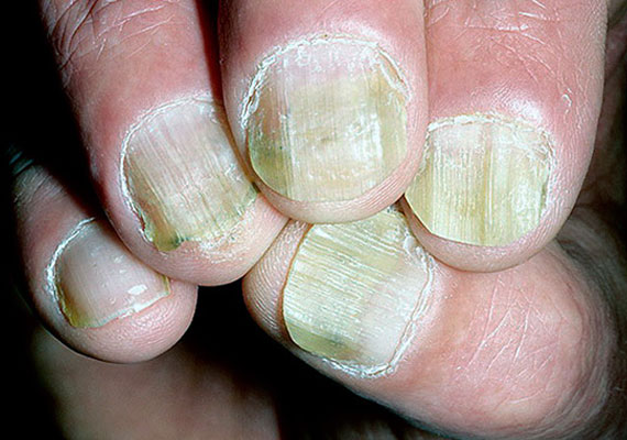 指甲银屑病症状
