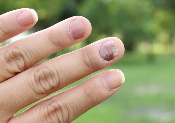 银屑病指甲病变的原因