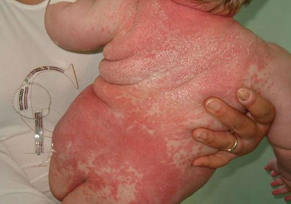 婴儿红皮病型银屑病图片
