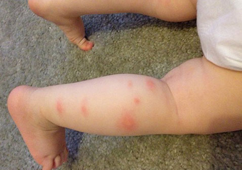 丘疹性荨麻疹的症状图片