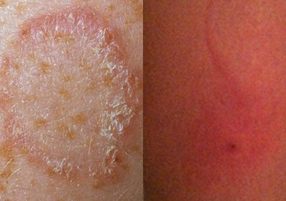 真菌和寄生虫引起皮疹症状图片