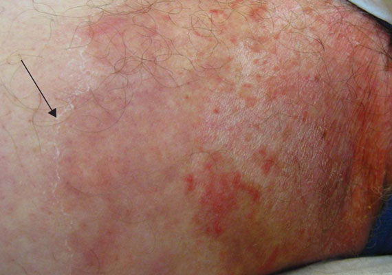 真菌性皮肤病股癣症状图片