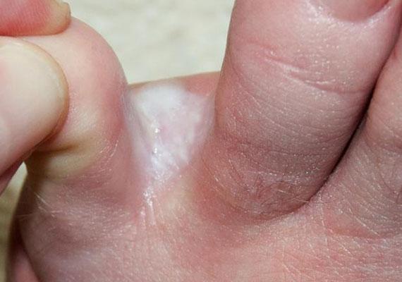 真菌性皮肤病脚癣症状图片