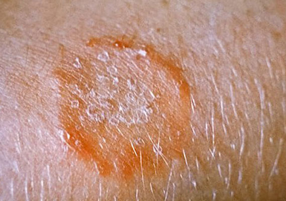 真菌性皮肤病癣的症状图片