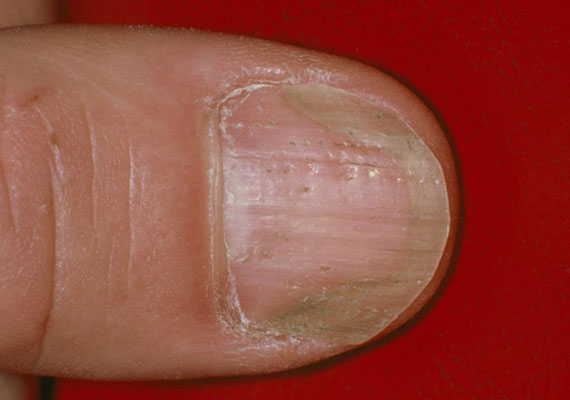 指甲牛皮癣症状图片