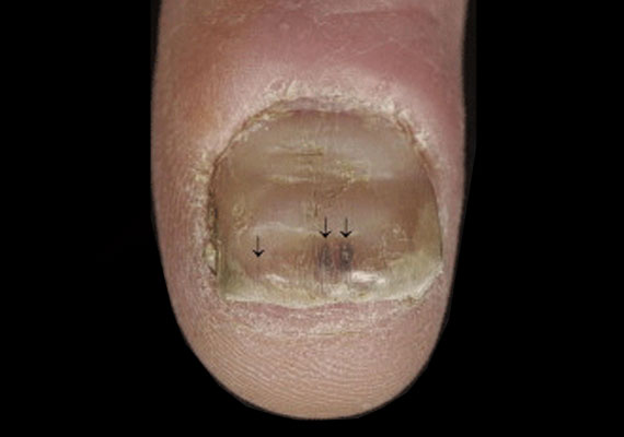 指甲银屑病初期症状