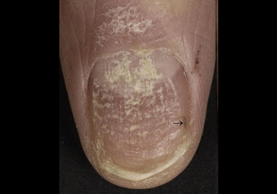 指甲银屑病最初症状图片