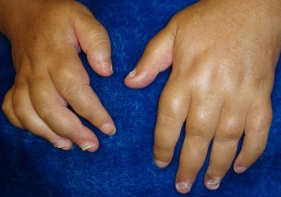 指甲银屑病和手指银屑病关节炎图片