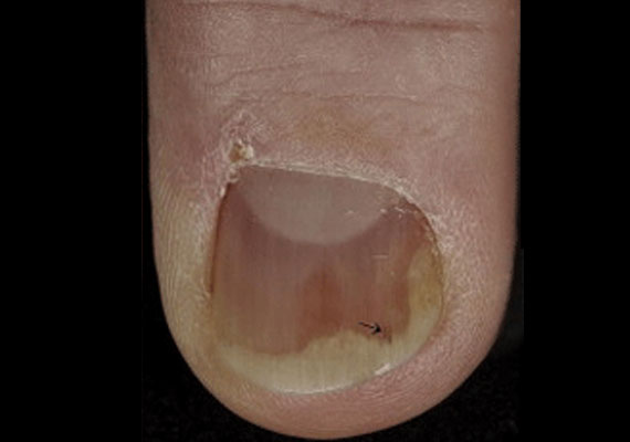 指甲银屑病早期常见症状