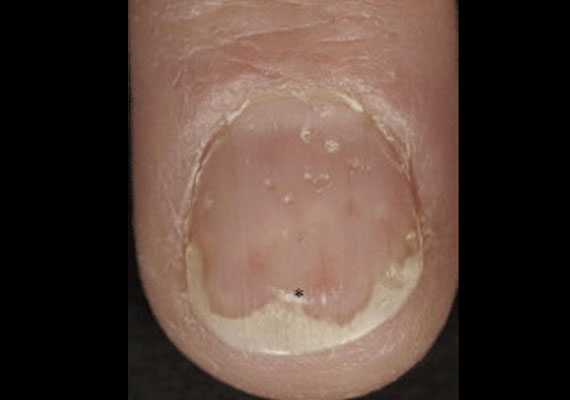 指甲银屑病早期症状图