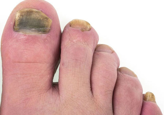 脚趾甲真菌脚气的症状图片