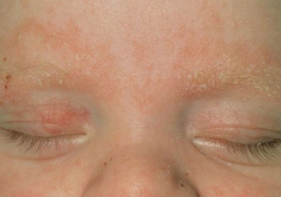 脂溢性皮炎早期症状图片