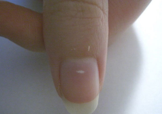 最轻微的手指甲白色浅表灰指甲图片