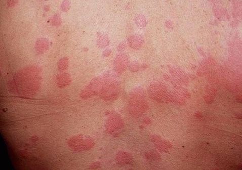 背部荨麻疹风疹块图片
