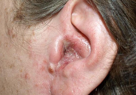 耳朵耳道湿疹症状图片