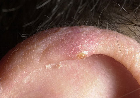 耳朵耳廓湿疹症状图片